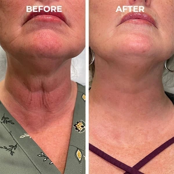 Last Day Promotion 49% OFF - š„Botox Face Serum