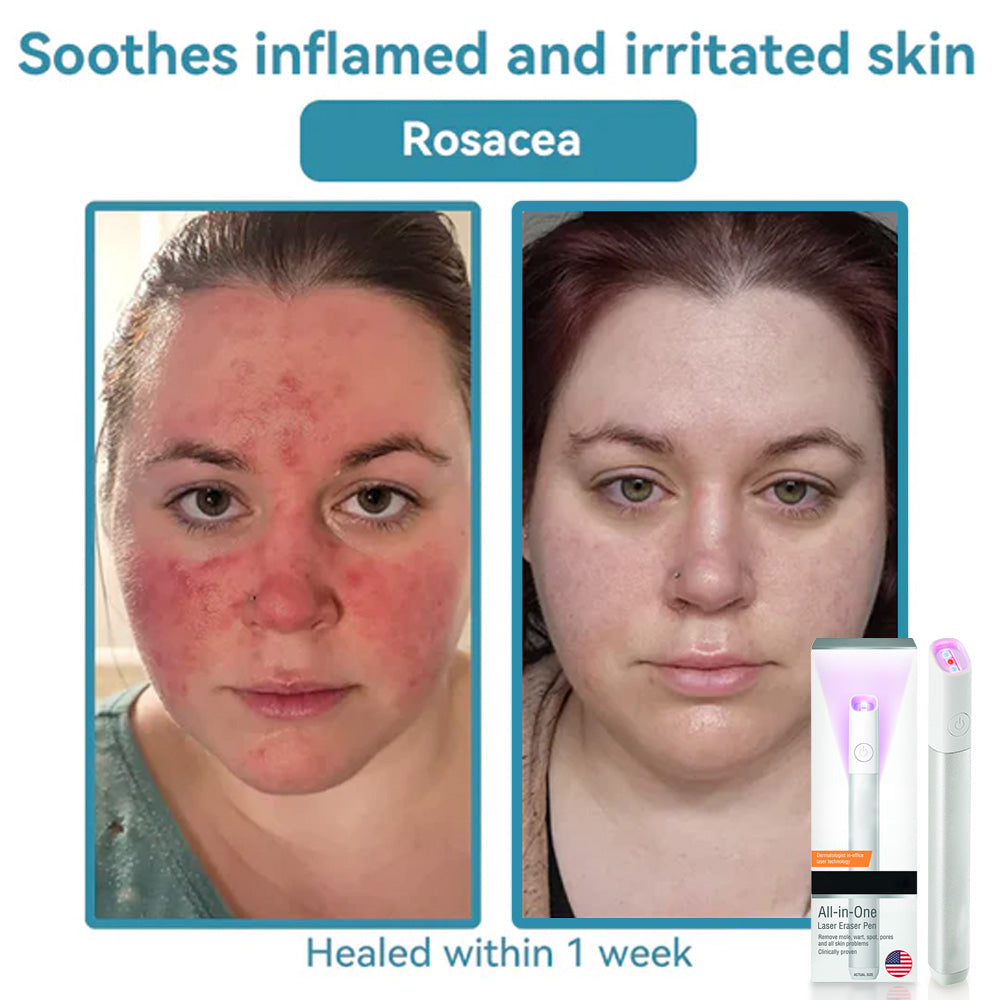 ✨All-in-One CO₂ Laser Eraser Pen | Removes Moles, Warts, Skin Flaws & Pigmentation